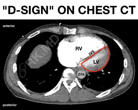 d-shaped heart strain